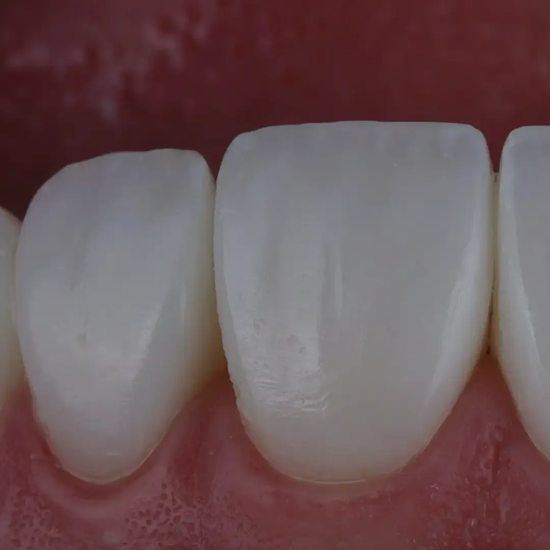 Composite veneer layering technique — clinical close-up