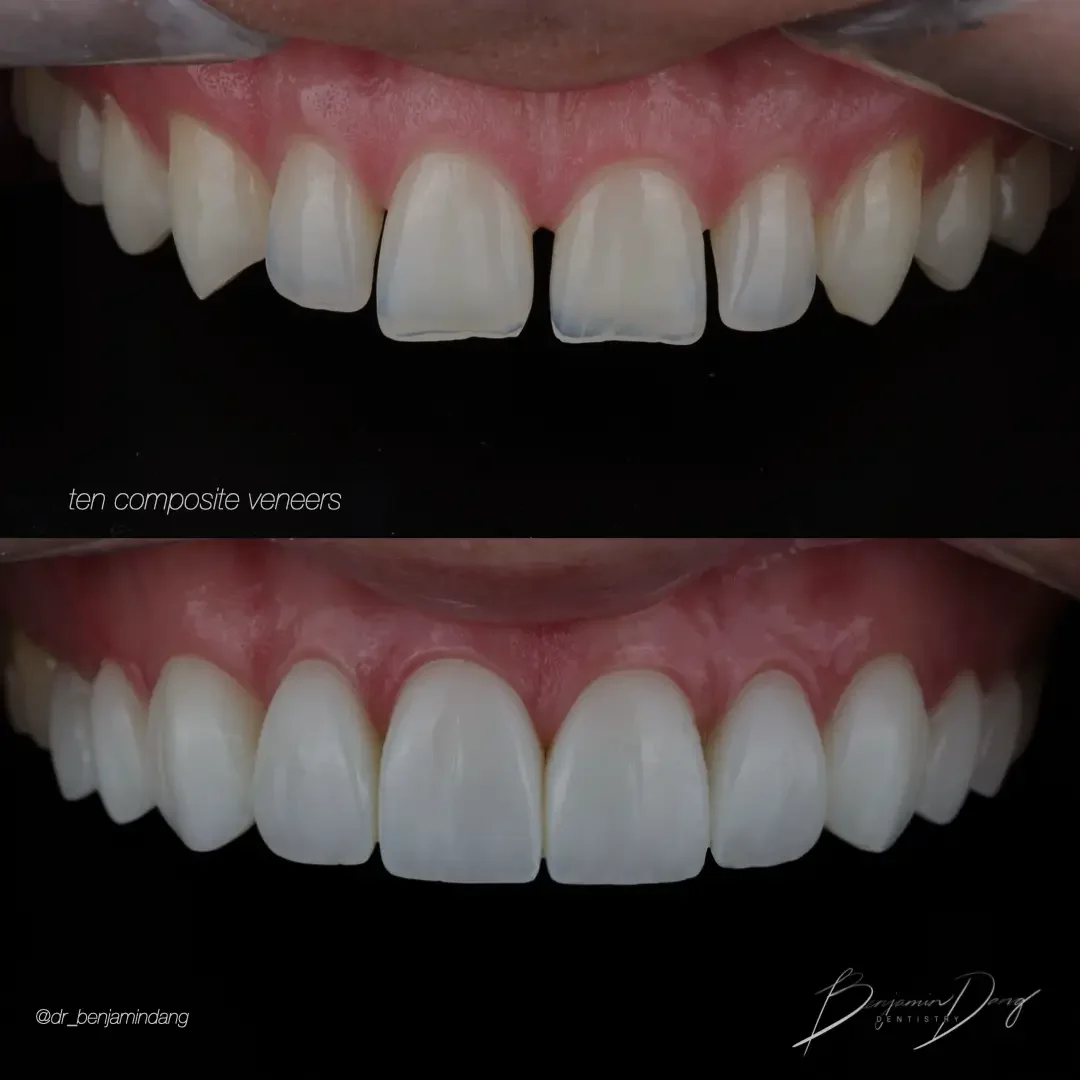 Ten composite veneers — full arch