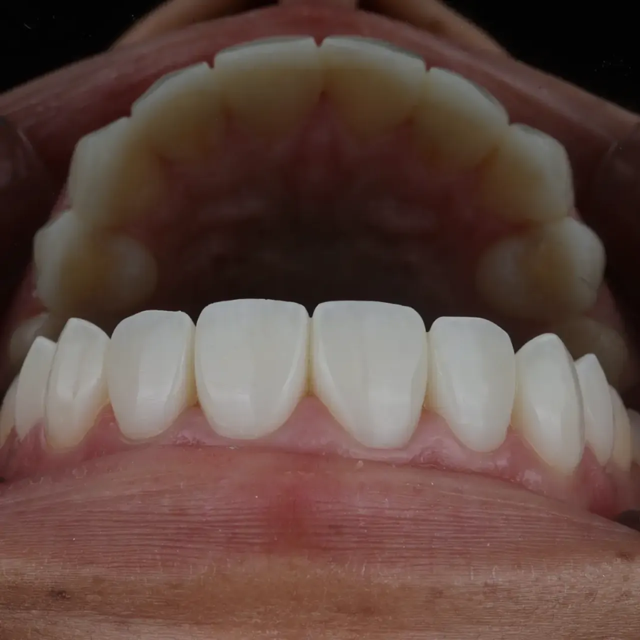 Composite veneers — completed result