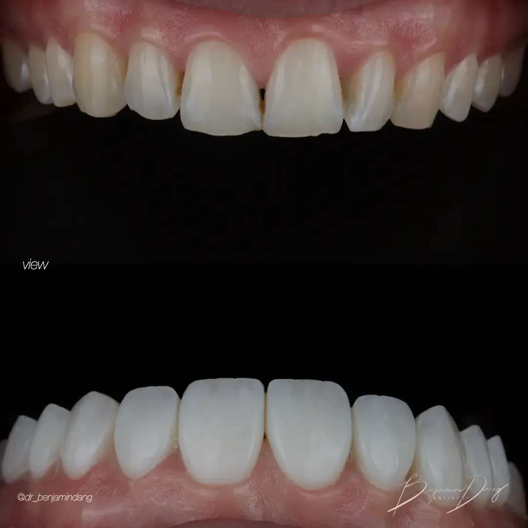 Composite veneers before and after — case two