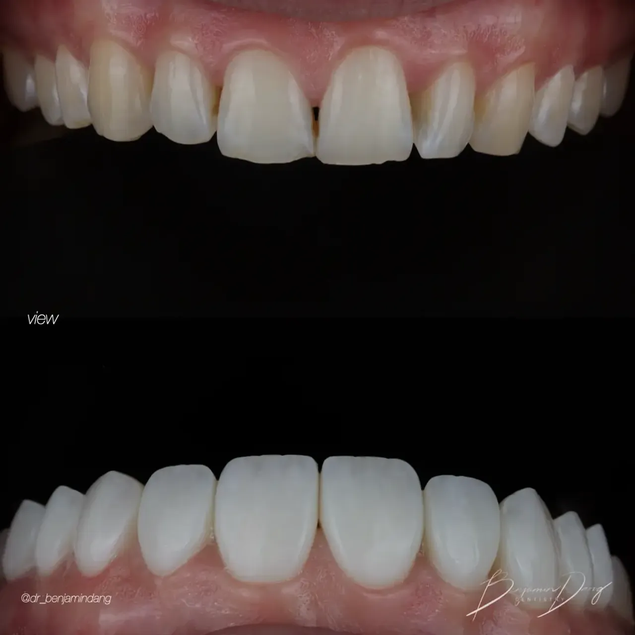 Composite veneers before and after — case two