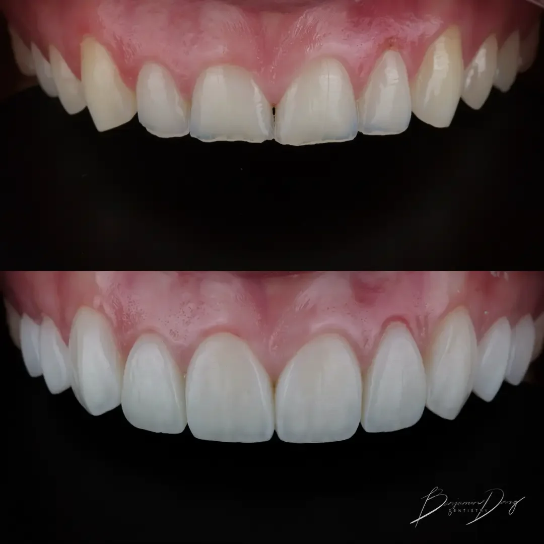 Composite veneers before and after — case three