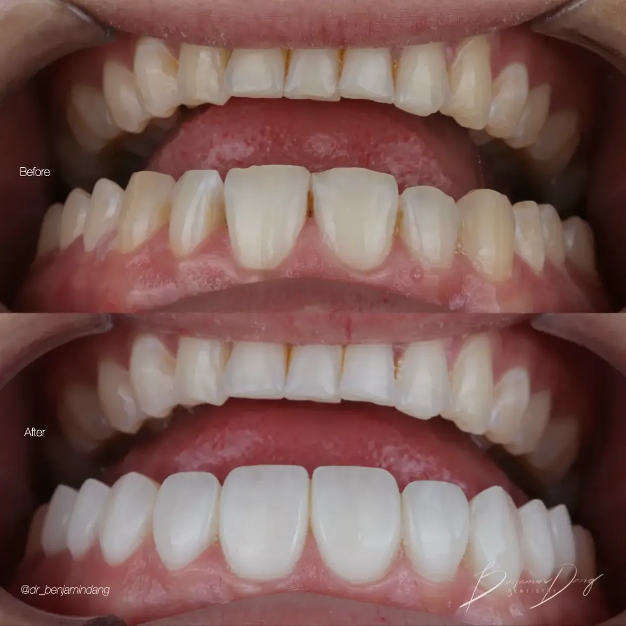 Composite veneers before and after