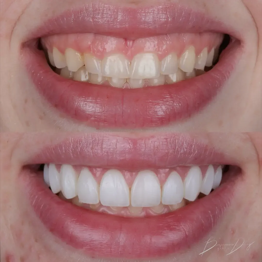 Composite veneers with gum lift