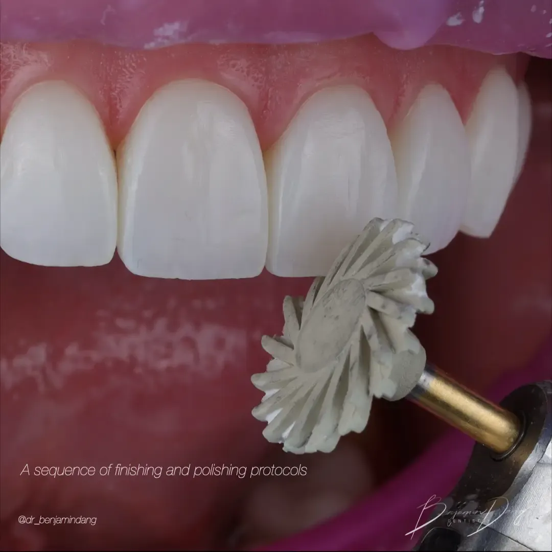 Composite veneer layering technique — clinical close-up