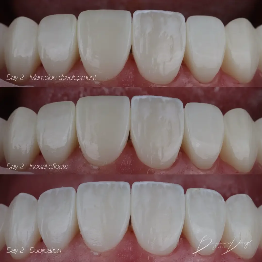 Composite veneer layering process