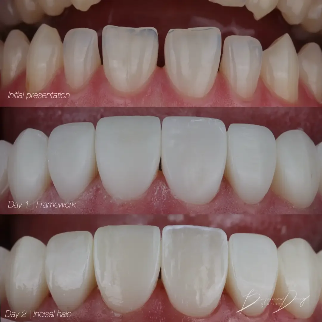 Composite veneer application process
