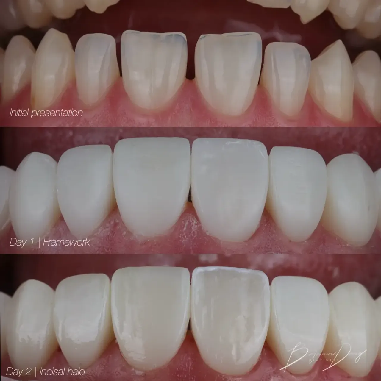 Composite veneer application process