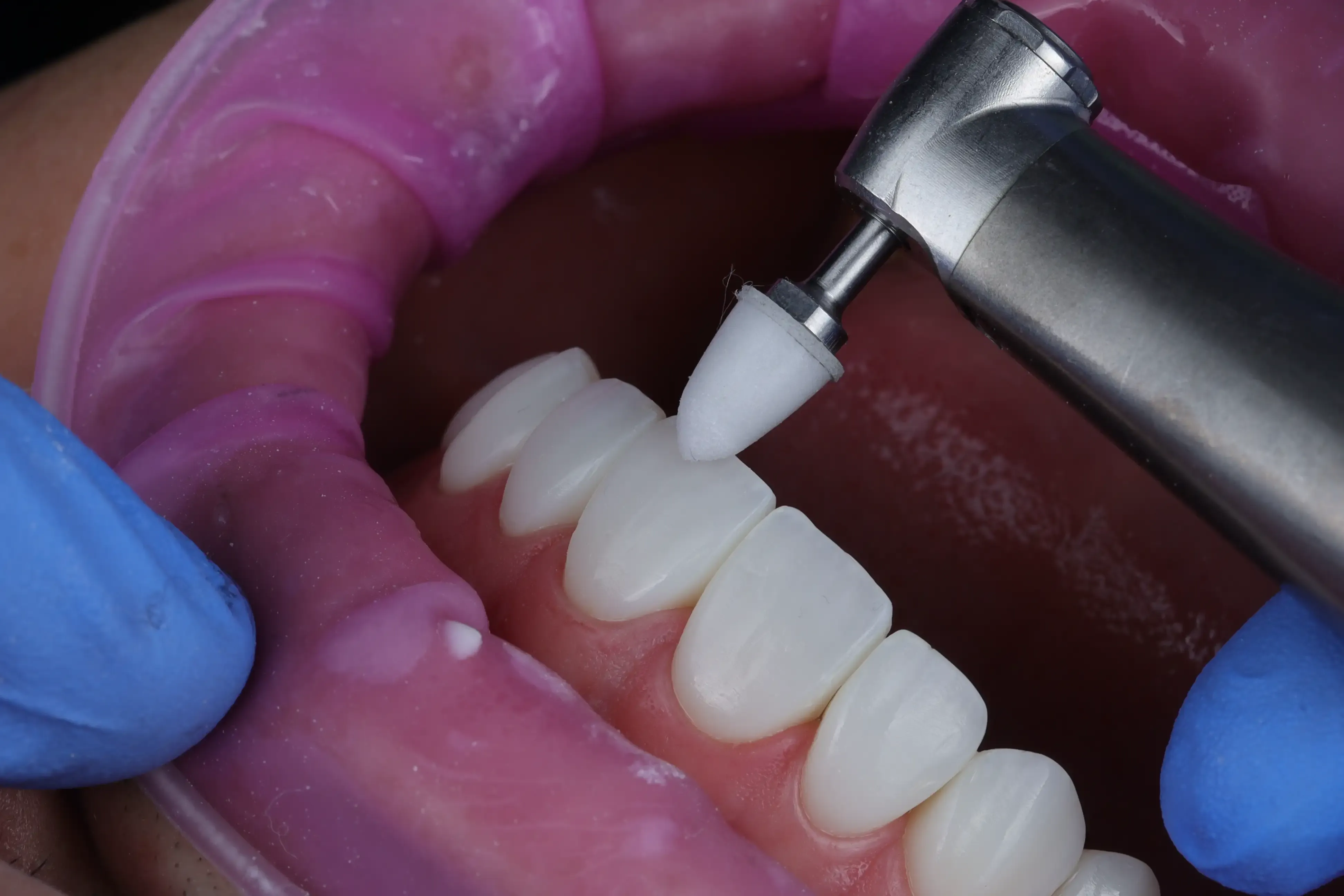 Composite veneer procedure — close-up clinical photography