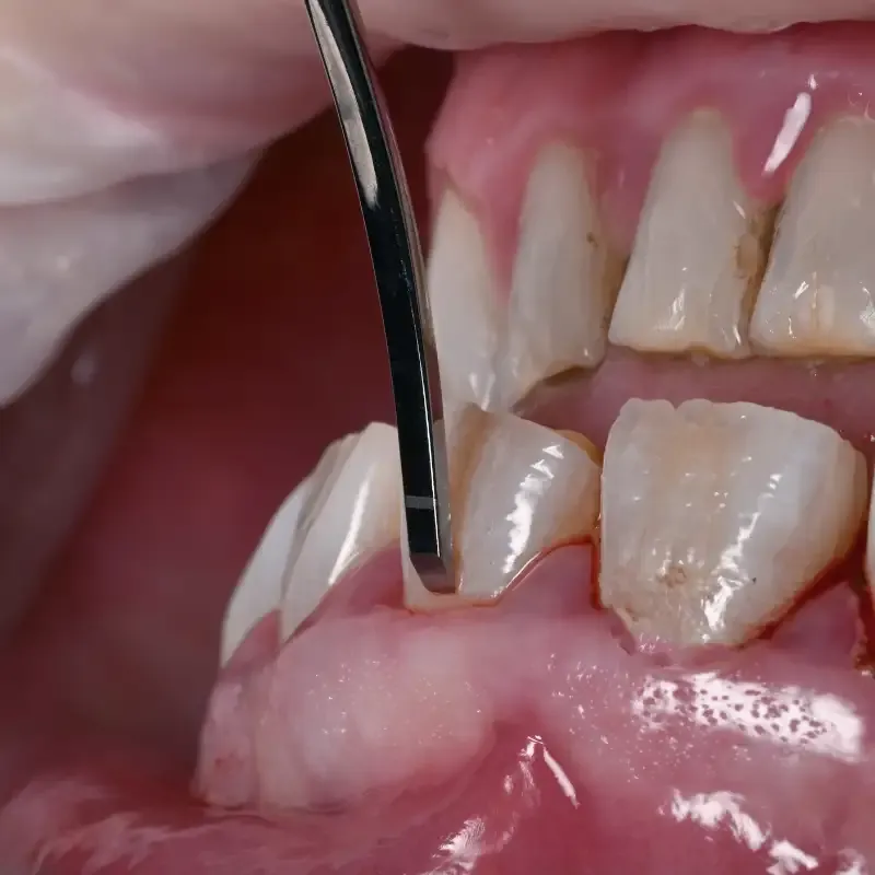 Crown lengthening technique — clinical close-up