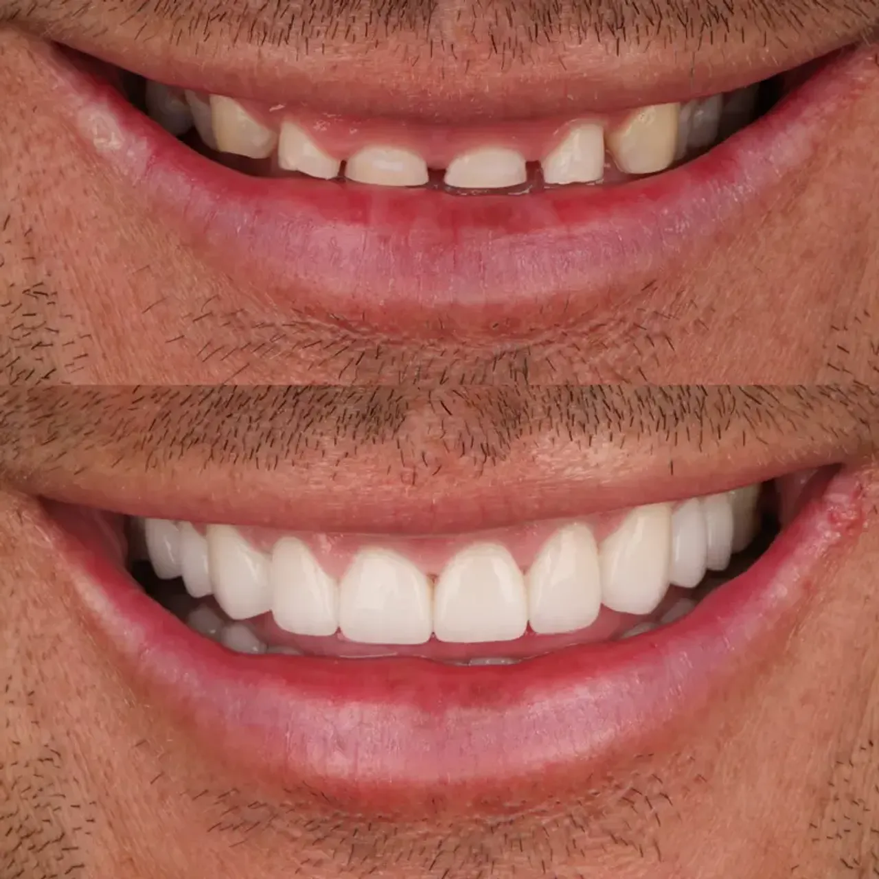 Crown lengthening before and after