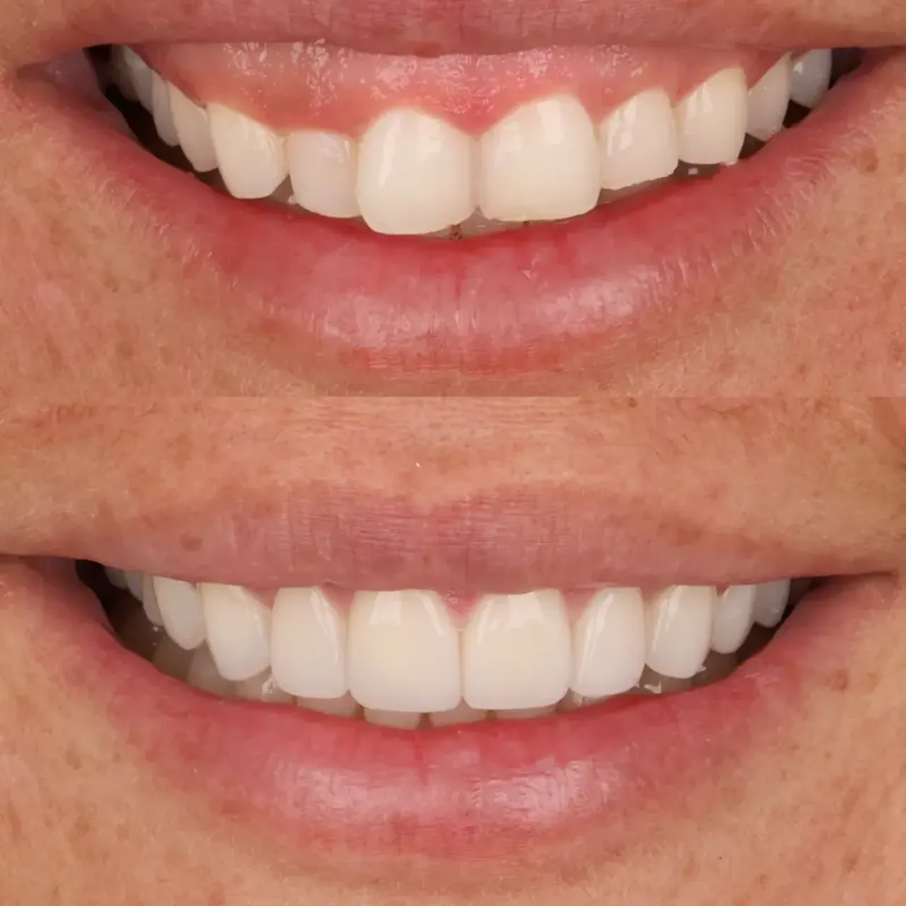 Gummy smile correction before and after