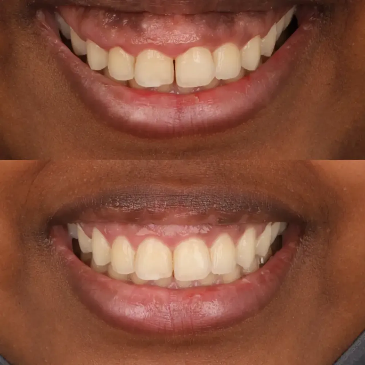 Crown lengthening before and after