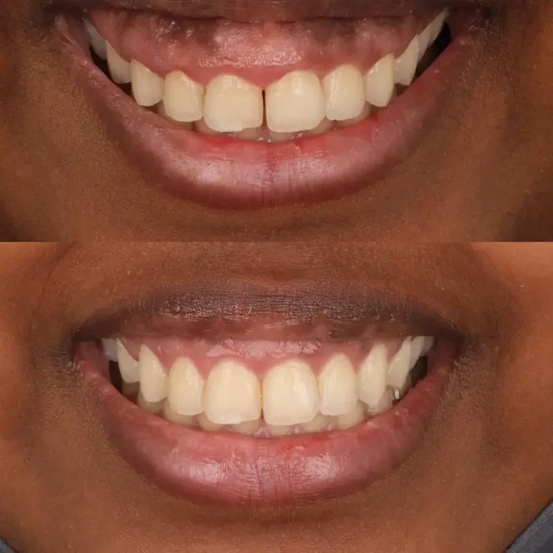 Crown lengthening before and after