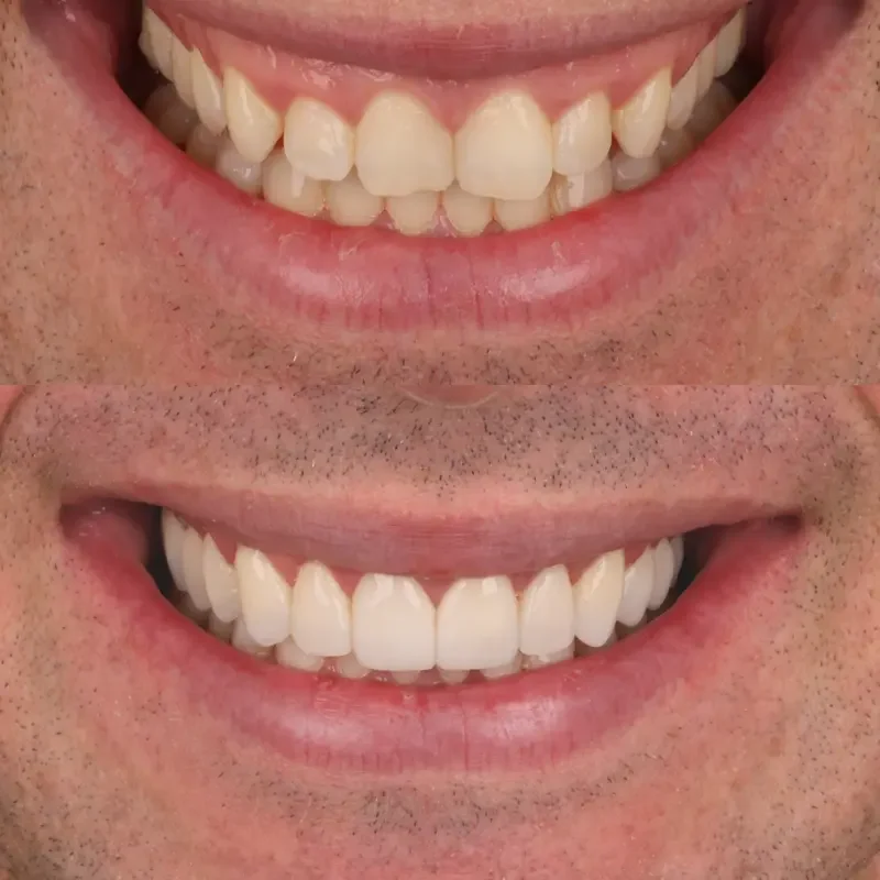 Aesthetic crown lengthening before and after