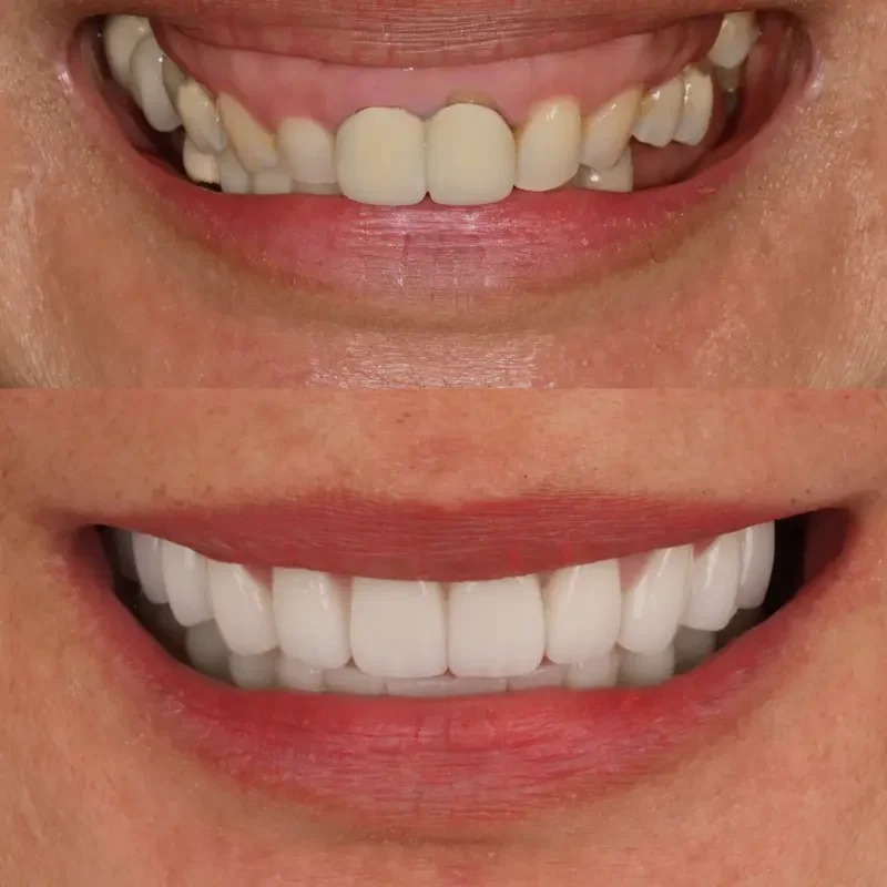 Gummy smile management before and after