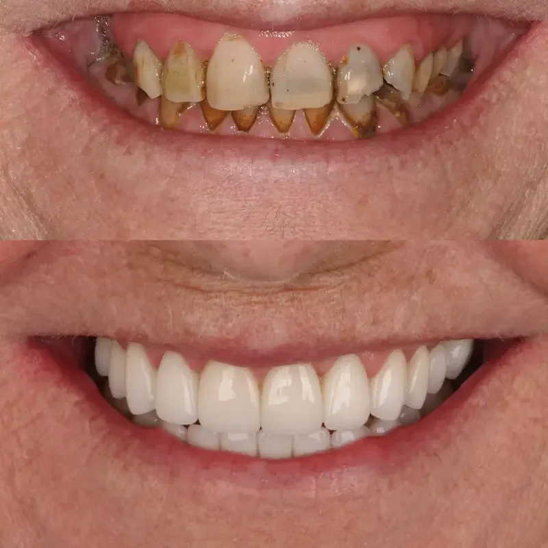 Full mouth rehabilitation before and after