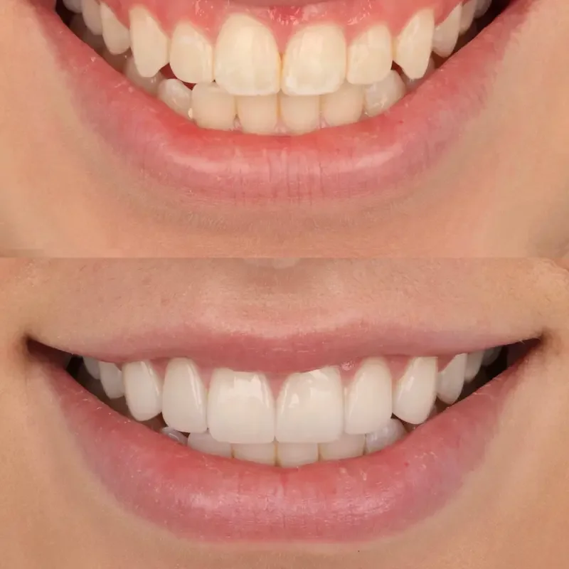 Crown lengthening before and after