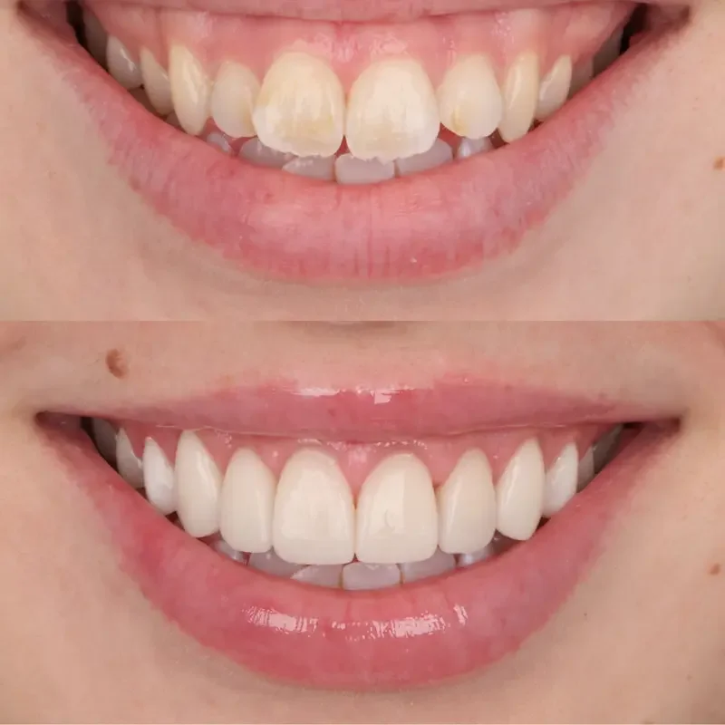 Aesthetic crown lengthening before and after