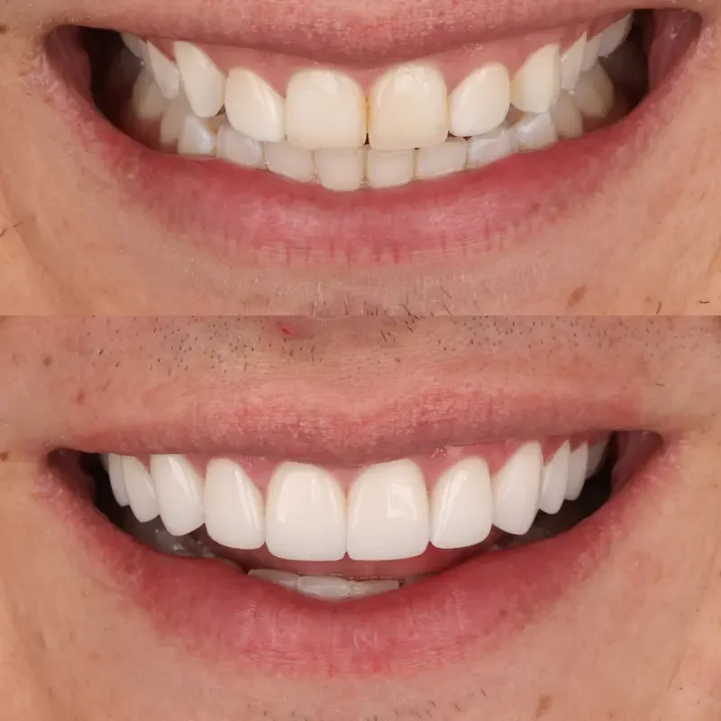 Crown lengthening before and after